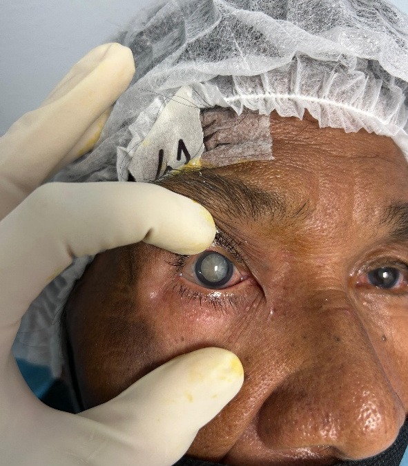 Intervenciones de cataratas para la mejora de la salud visual en las comunidades del sur de Honduras